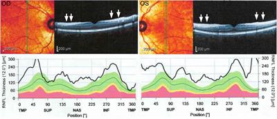 Case Report: Expanding the Genetic and Phenotypic Spectrum of Autosomal Recessive Spastic Ataxia of Charlevoix-Saguenay